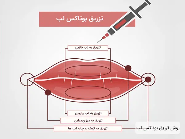 بوتاکس لب در استان گیلان شهر رشت در کلینیک زیبایی مهتاب لیزر: همه آنچه باید بدانید